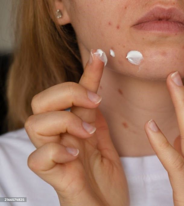 Pelle Impura e Acne? La Risposta è nella Natura: Scopri la linea Iyoskin Acnecare